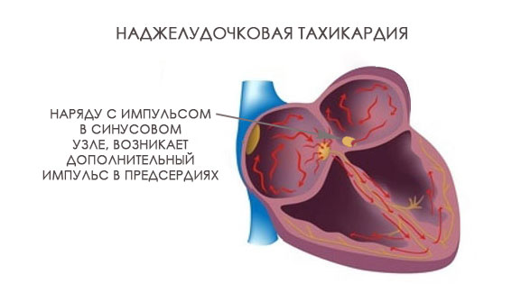 в-синусовом-узле-возникает-дополнительный-импульс наджелудочковая-тахикардия