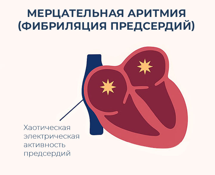 тип-нарушения-ритма-сердца-при-котором-предсердия-сокращаются-хаотично-и-крайне-быстро мерцательная-аритмия