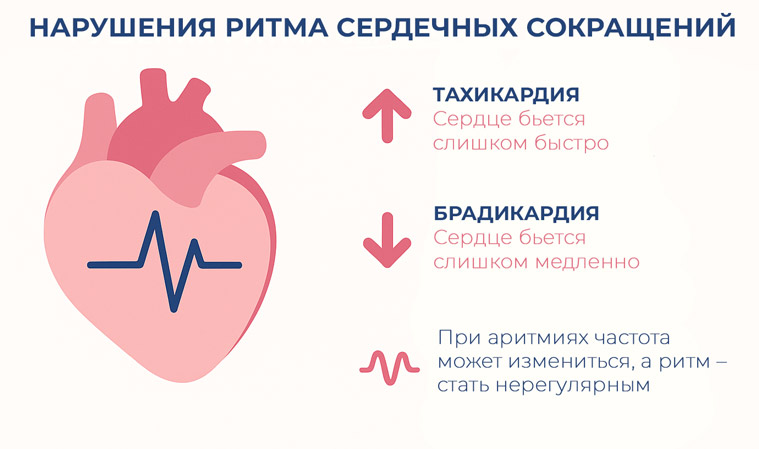 при-аритмиях-частота-может-измениться-сердце-бьется-слишком-быстро-тахикардия-или-слишком-медленно-брадикардия-а-ритм-стать-нерегулярным нарушения-ритма-сердечных-сокращений