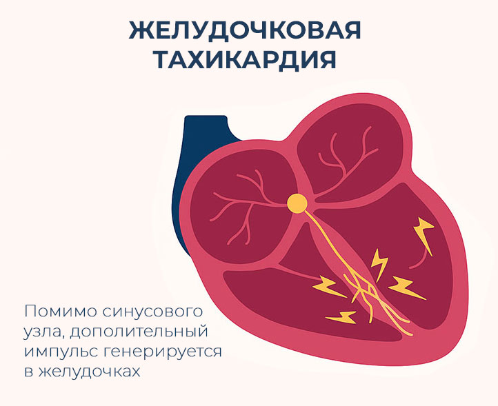 учащенный-сердечный-ритм-источником-которого-являются-сами-желудочки-нижние-камеры-сердца желудочковая-тахикардия