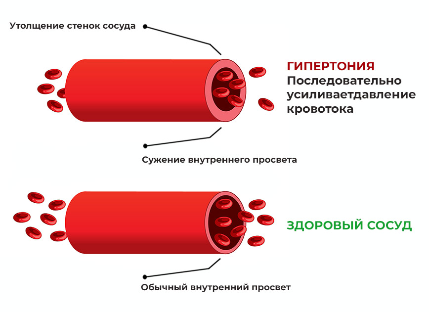 стойкое-повышение-кровяного-давления-выше-нормы изменения-в-сосудах-при-артериальной-гипертензии